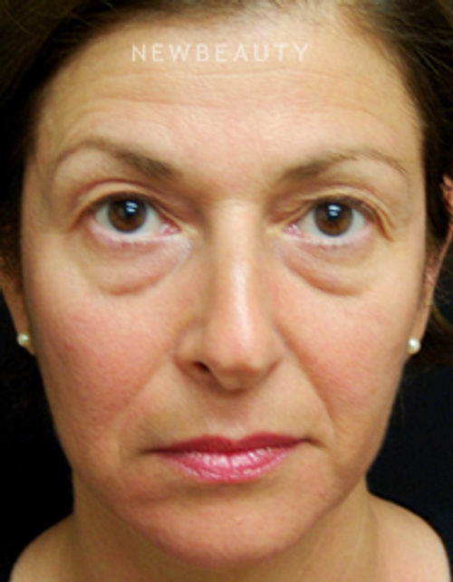 Dr. Mokhtar Asaadi - Blepharoplasties - Before