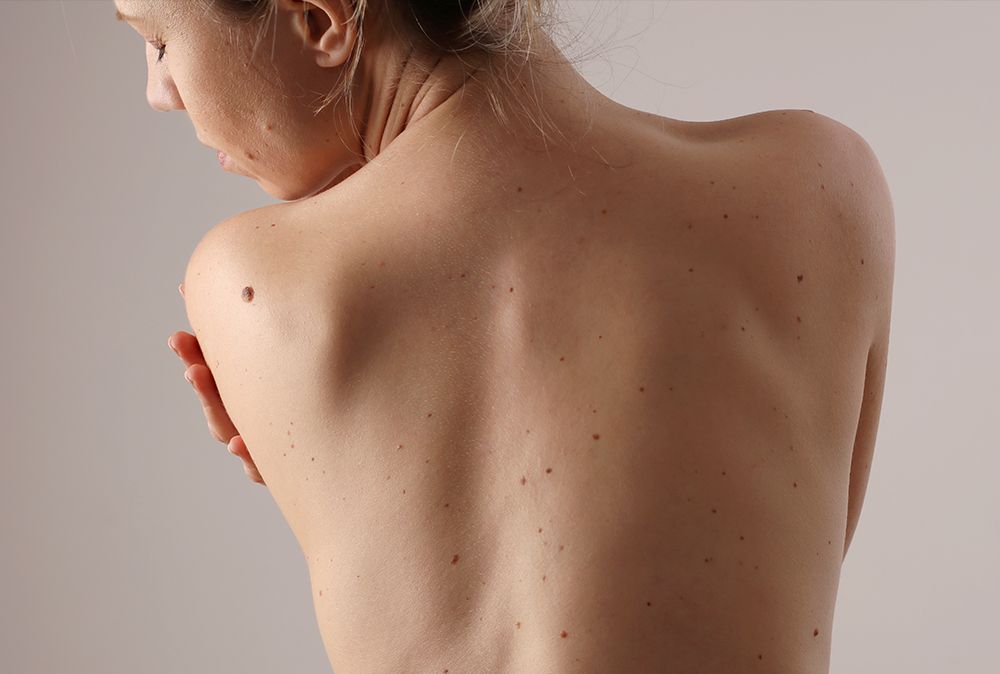 woman's bare back with sparse moles