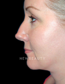 Dr. Kelly Bomer Facelift, Necklift - After