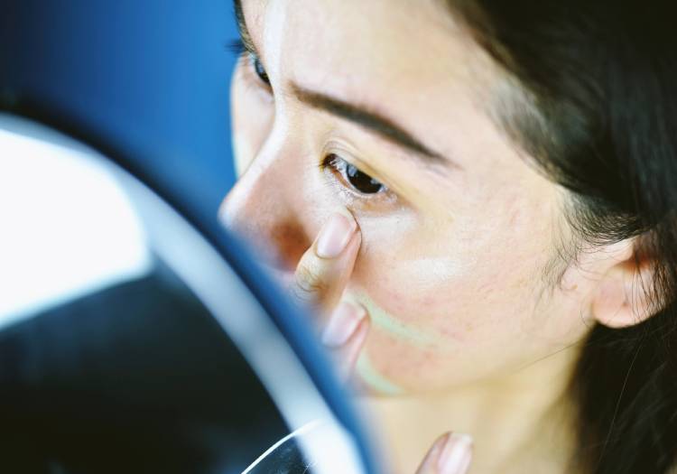 A woman with acne-prone skin applies concealer under her eye while looking in a mirror.