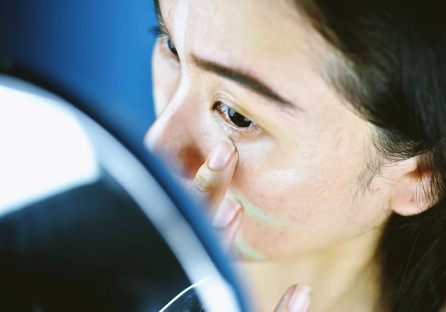 A woman with acne-prone skin applies concealer under her eye while looking in a mirror.