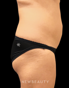 Dr. Janet Allenby - CoolSculpting - Before