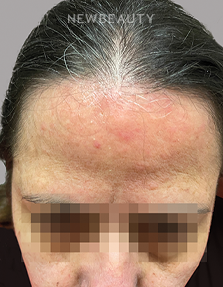 Dr. Anna Chacon - Facial Dermatitis - 34291093 - After