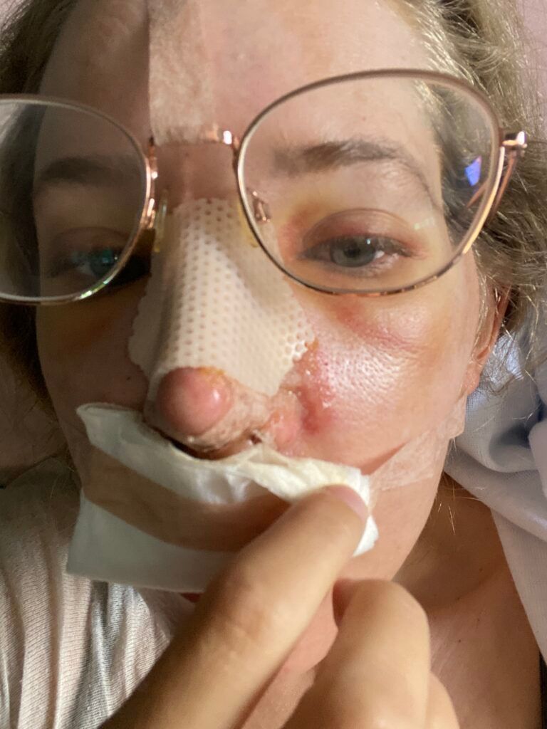 Jillian Gottlieb rhinoplasty surgery 2