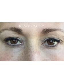 Dr. Janet Allenby - Kybella - After