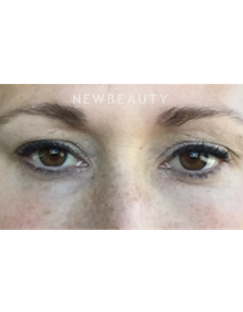 Dr. Janet Allenby - Kybella - After