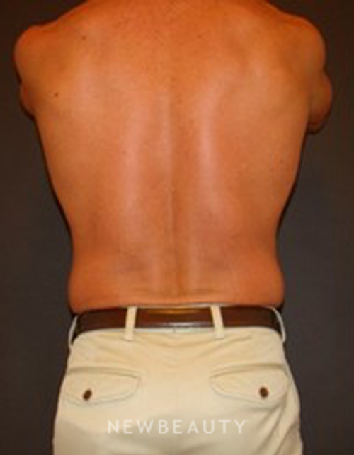 Dr. Joel Schlessinger - Coolsculpting - Before