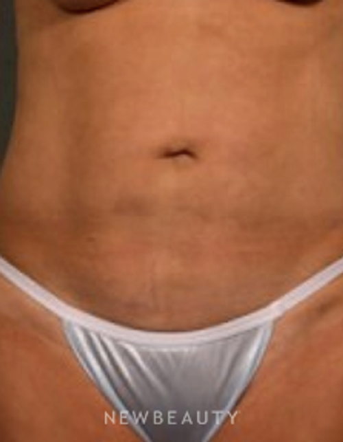 Dr. Aviva Preminger - Liposuction - After