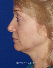 Dr. Konstantin Vasyukevich - Facelift - Before