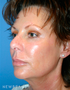 Dr. Kelly Bomer Liquid Facelift - After