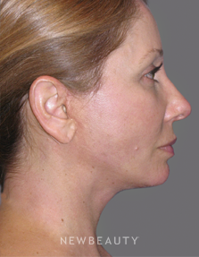 Dr. Min Ahn - Mini-Facelift & Necklift - After