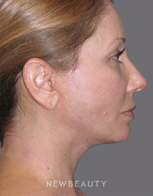 Dr. Min Ahn - Mini-Facelift & Necklift - After