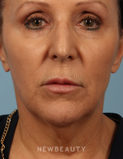 Dr. Carmen M. Kavali - Contour Correction - Before