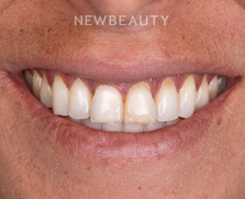 Dr. Husam Almunajed - Smile Makeover - 41358035 - Before