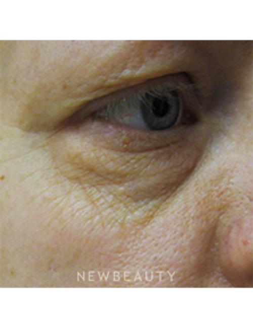 Dr. Kally Papantoniou - Pixel CO2 Laser Resurfacing - Before