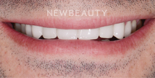Dr. Nathan Hoffman - Crowns & Veneers - After