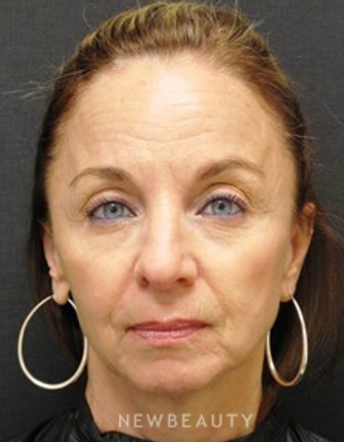 Dr. Janet Allenby- Botox - Before