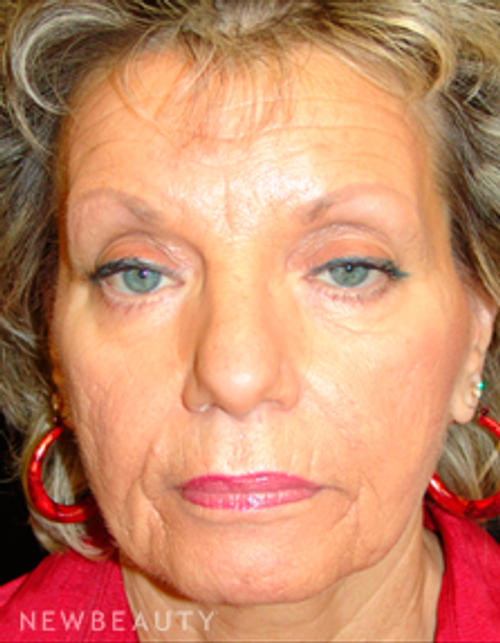 Dr. Mokhtar Asaadi Facelift, Eyelid Lift - Before