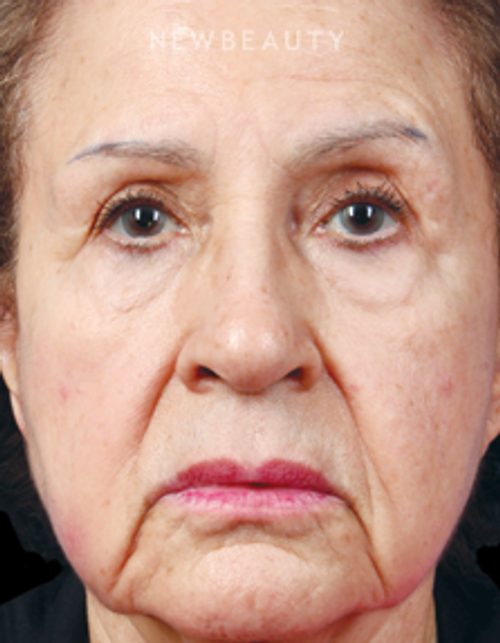 Dr. Kathleen Behr - Injectables - Before
