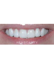 Dr. Guy Lewis Veneers - After