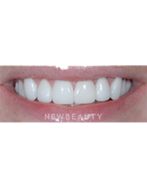 Dr. Guy Lewis Veneers - After