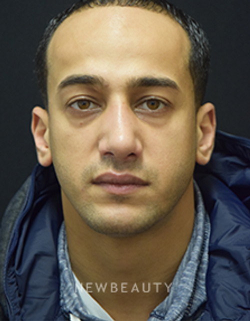 Dr. Jeffrey B. Wise - Rhinoplasty - After