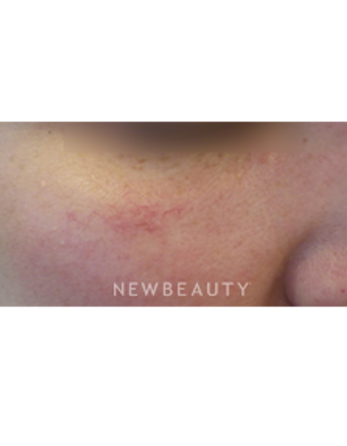 Dr. Kally Papantoniou - KTP Laser Treatment - Before