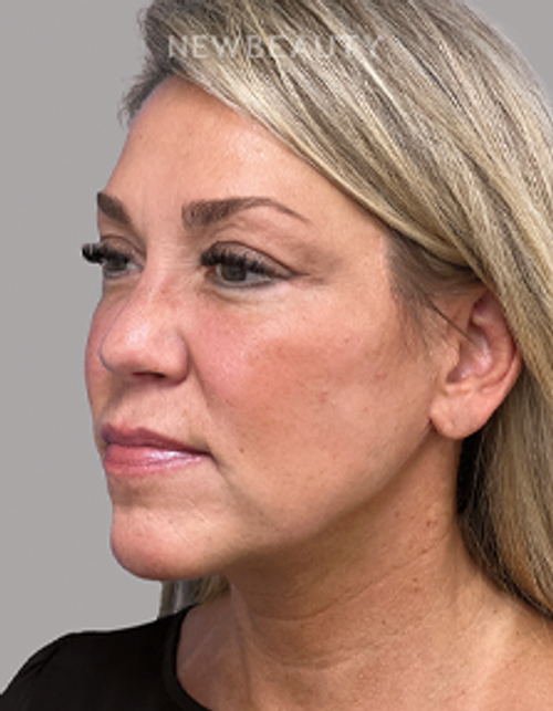 Dr. Michael A. Epstein - Elegant Facial Rejuvenation - 33109024 - After