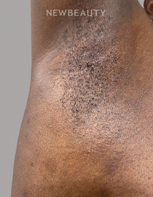 Dr. Anna Chacon - Skin Infection - 34279887 - After