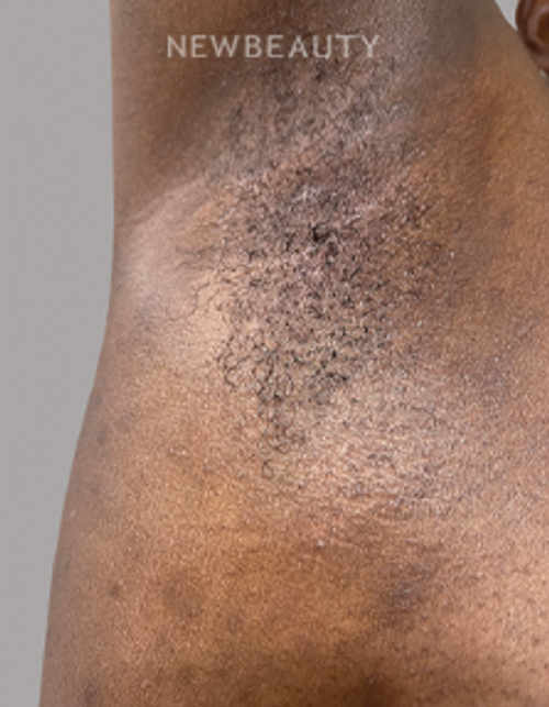Dr. Anna Chacon - Skin Infection - 34279887 - After