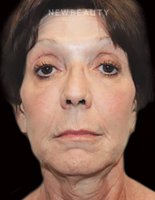Dr. Joel Schlessinger - A Softer Look - After