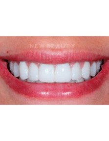 Dr. Guy Lewis Veneers - After