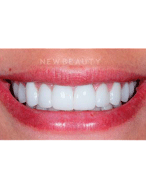 Dr. Guy Lewis Veneers - After