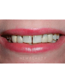Dr. Guy Lewis Dental Implants - Before