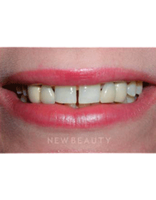 Dr. Guy Lewis Dental Implants - Before