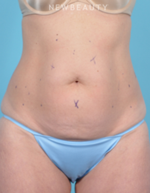 Dr. Bradley Bengtson - CoolSculpting - Before