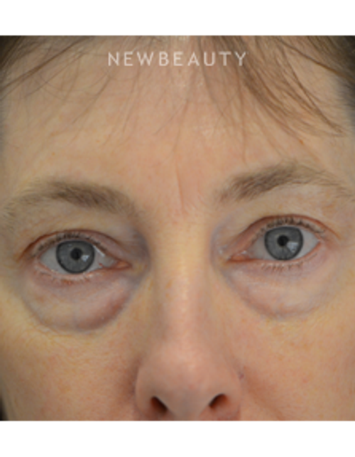 Dr. B. Aviva Preminger - Eyelift - Before