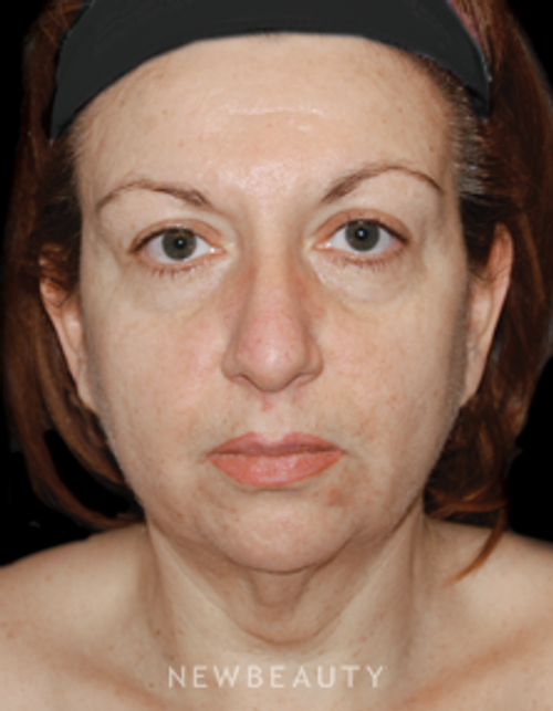 Dr. Roman Rayham - Defining Beauty - Before