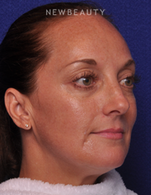 Dr. Alan J. Durkin - Injectables and Fillers - Before