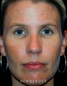 Dr. Kelly Bomer Liquid Facelift - Before