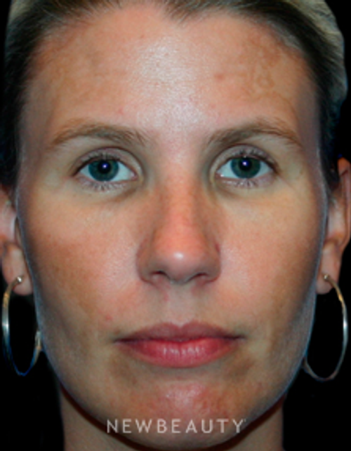 Dr. Kelly Bomer Liquid Facelift - Before