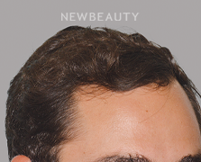 Dr. Anthony Bared - Hair Transplant - 46164621 - After