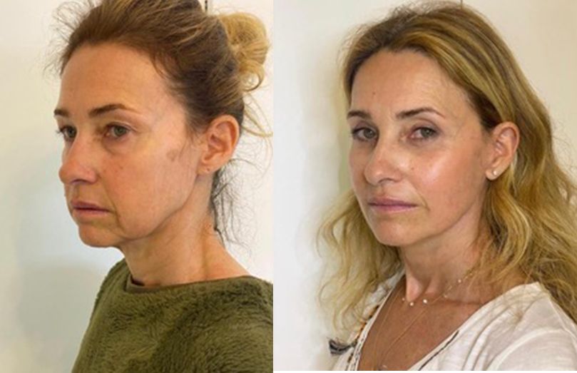 French face lift before and after