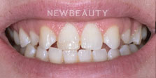 Dr. Nathan Hoffman - Dental Implants - Before