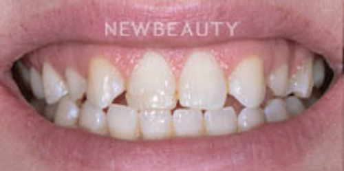 Dr. Nathan Hoffman - Dental Implants - Before