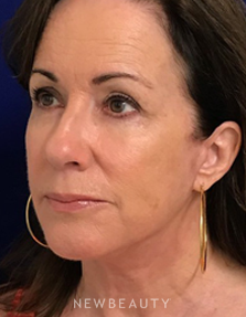 Dr. Dilip Madnani - Facelift - After