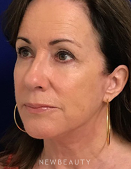 Dr. Dilip Madnani - Facelift - After