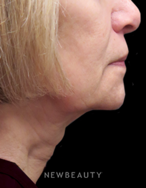 Dr. Elie Levine - Liposuction - Before