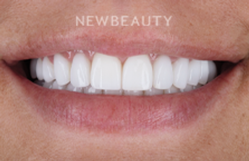 Dr. Robert Klaich - Sparkling Smile - 24010377 - After