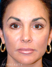 Dr. Kelly Bomer Rhinoplasty - After